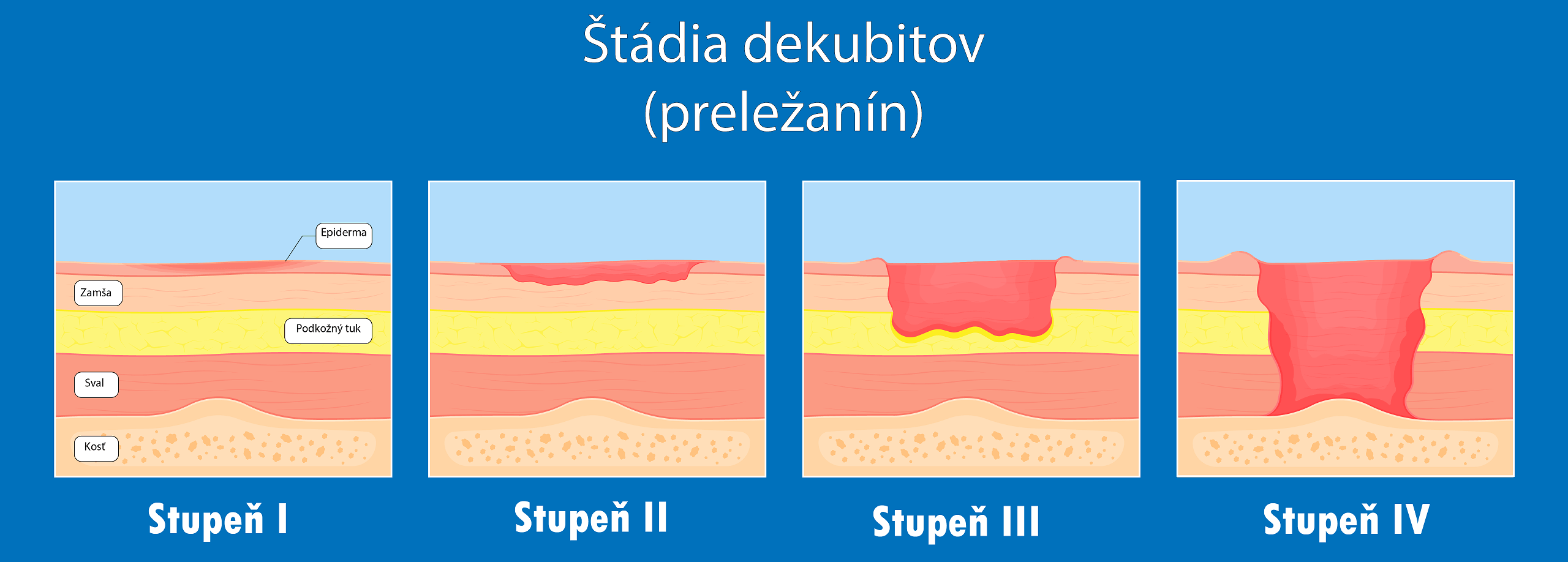 Stadia dekubitov (2)